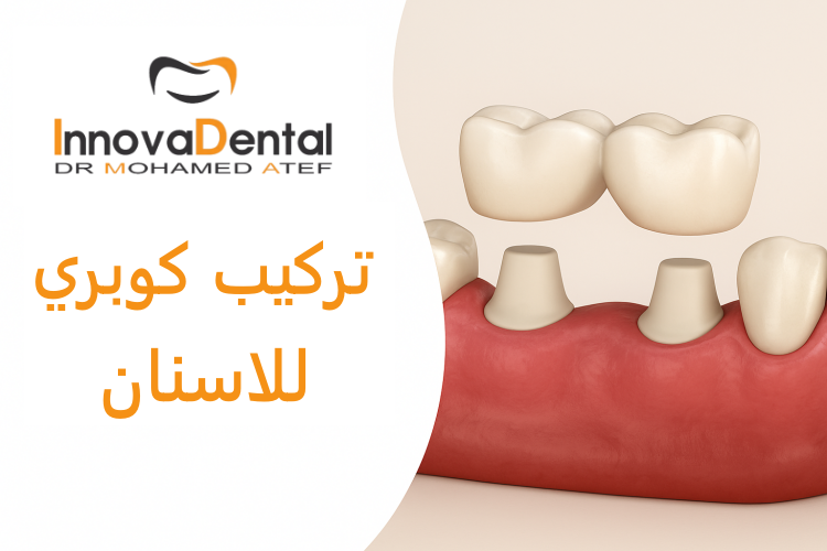 Dental bridge placement: the ideal solution for replacing missing teeth
